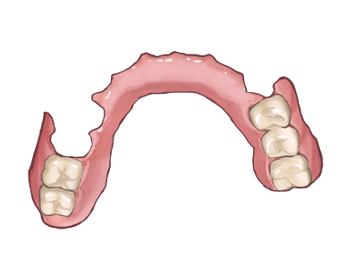 口蓋をくり抜いた部分入れ歯